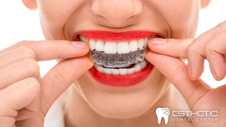 cuando-usar-alineadores-dentales