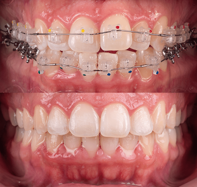 brackets antes y despues 2