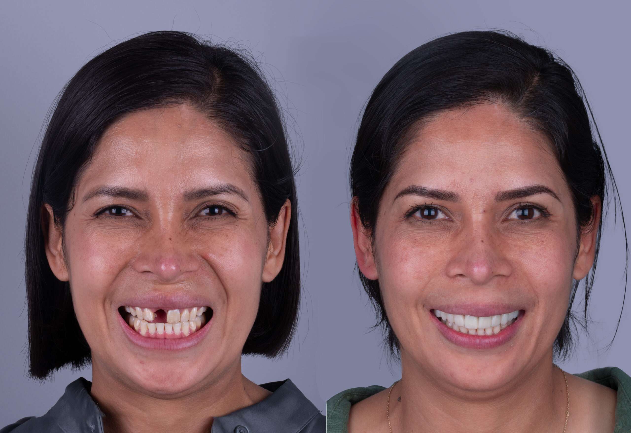 BEFORE AND AFTER implant front tooth