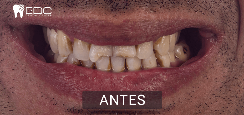 dentistas en queretaro antes