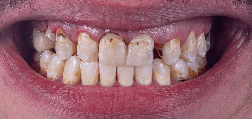 carillas-en-qro-antes carillas en qro antes