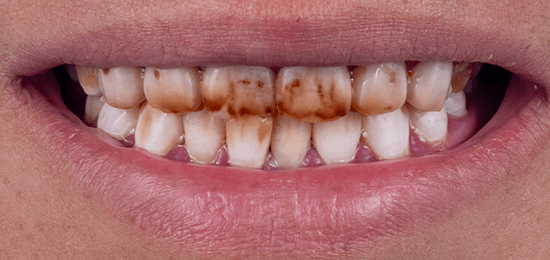 carillas-qro-antes-5 carillas qro antes 5