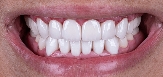 carillas queretaro despues