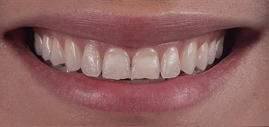 diseño-de-sonrisa-1 antes carillas qro antes 4