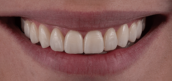 carillas qro despues 4