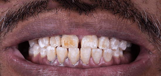 diseno-de-sonrisa-2-antes dentistas en queretaro antes 1