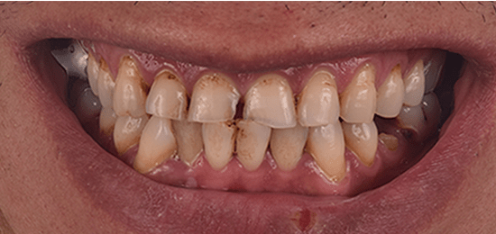 diseno-de-sonrisa-3-antes los mejores dentistas en queretaro antes 2