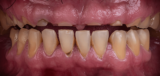 diseno-de-sonrisa-5-antes dentistas queretaro antes 3