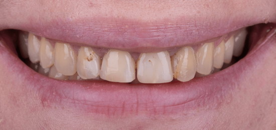 diseno-de-sonrisa-6-antes carillas queretaro antes 6