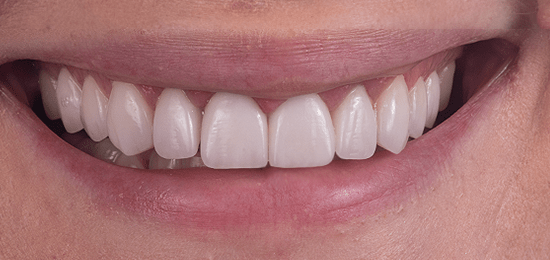 carillas queretaro despues 6