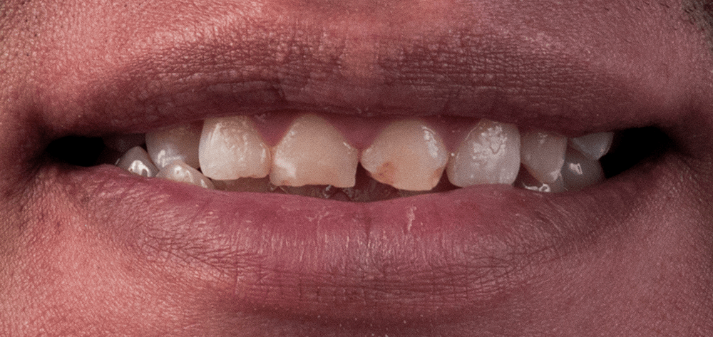 diseño de sonrisa antes 2025 diseño de sonrisa antes 2025