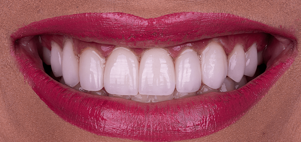 diseño de sonrisa despues