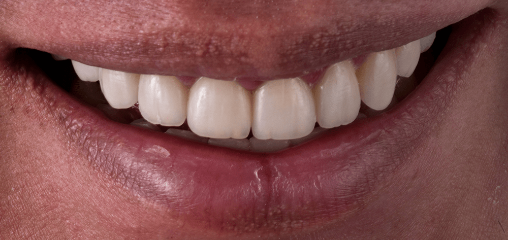 diseño de sonrisa despues 2025