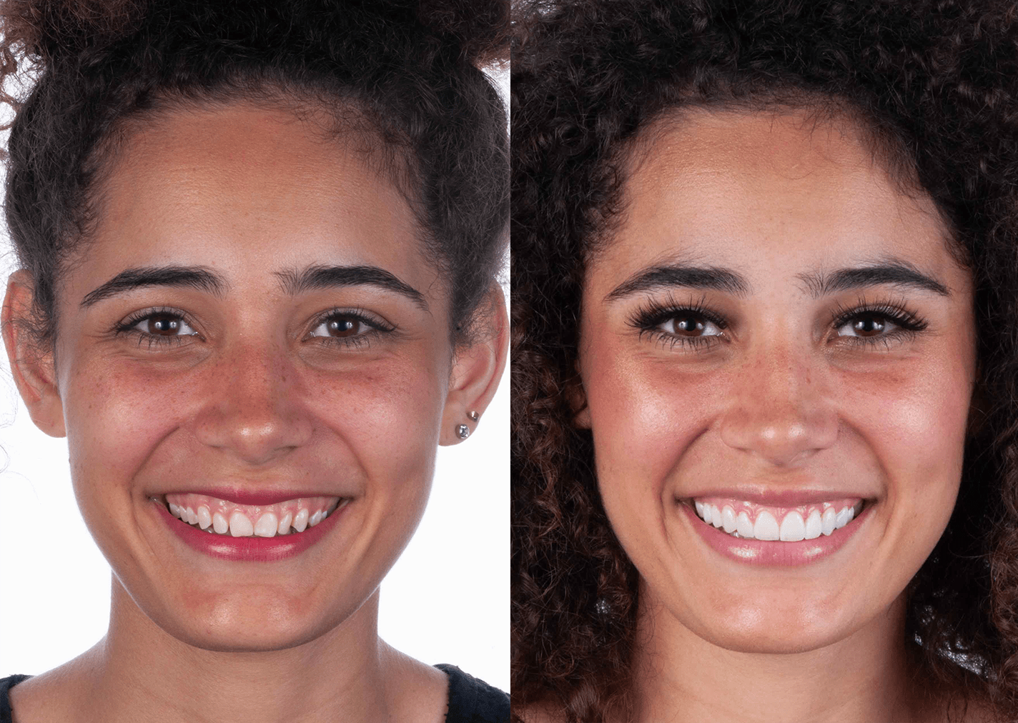 diseño de sonrisa qro