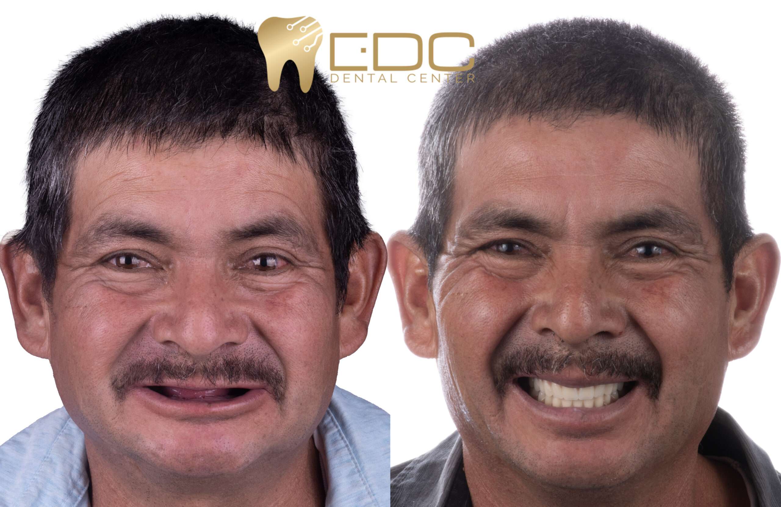 implants, all on six in queretaro