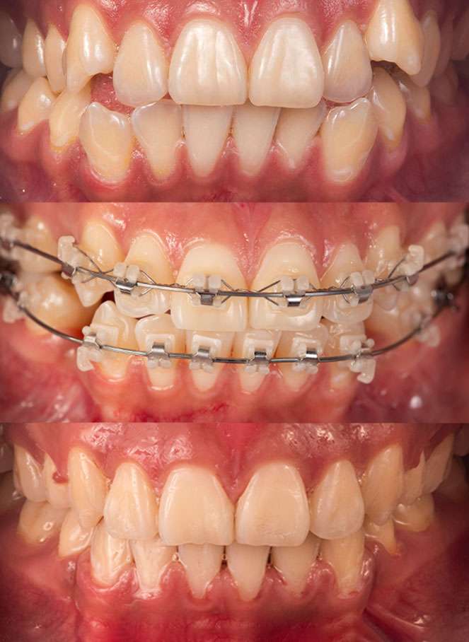 braquets antes y despues 1