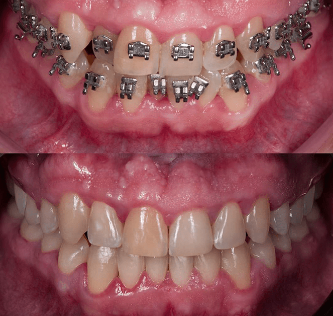 ortodoncia con braquets