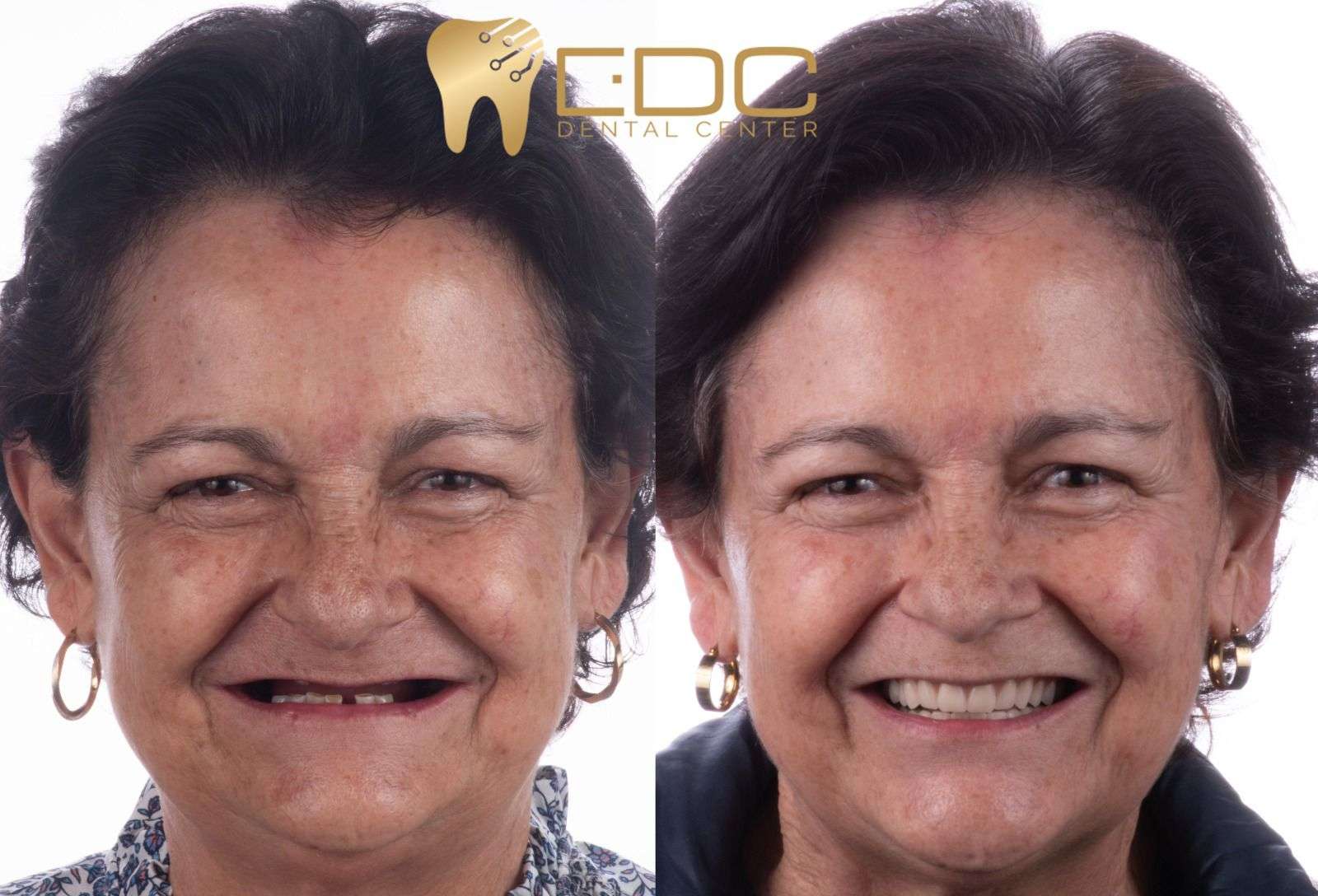 protesis dental queretaro