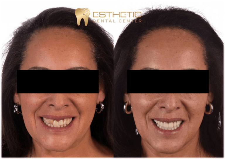 protesis total en qro