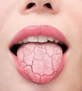 que es la xerostomia