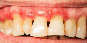 riesgos de la xerostomia